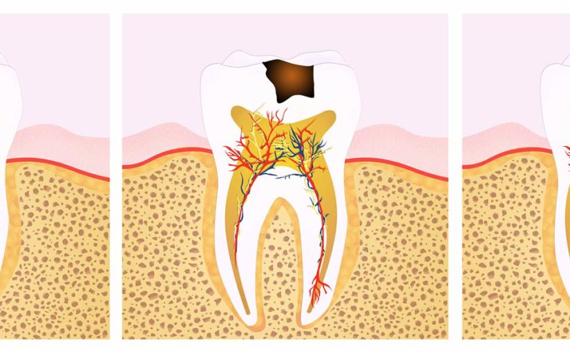 3 stage illustration of decaying tooth in need of root canal treatment