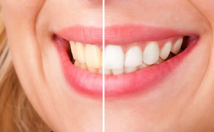 Close up of teeth before and after teeth whitening.