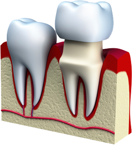 Dental Crown