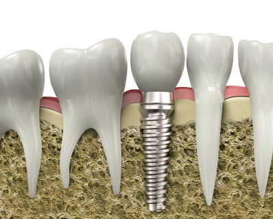 Dental Implants