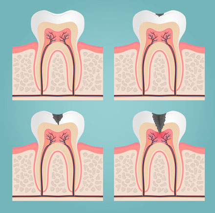 Root Canals